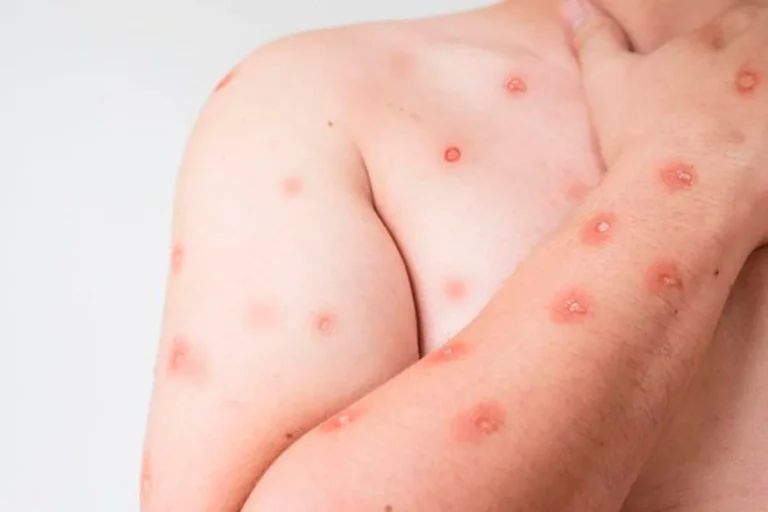 Bahia Registra Dois Casos de Mpox e Investiga Novas Suspeitas