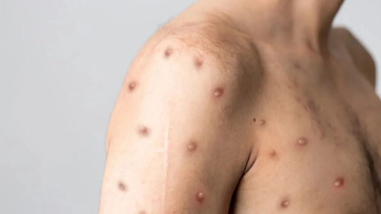 Mpox na Bahia: Casos Confirmados e O Que Você Precisa Saber Mpox na Bahia: Casos Confirmados e O Que Você Precisa Saber